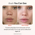 Bye Acne: 3-Minute Pimple Spot Treatment