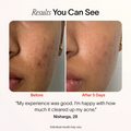 Bye Acne: 3-Minute Pimple Spot Treatment